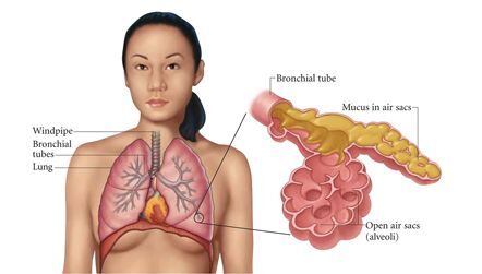 pneumonia treatment at home